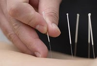 acupuncture st helens 648476 Image 0